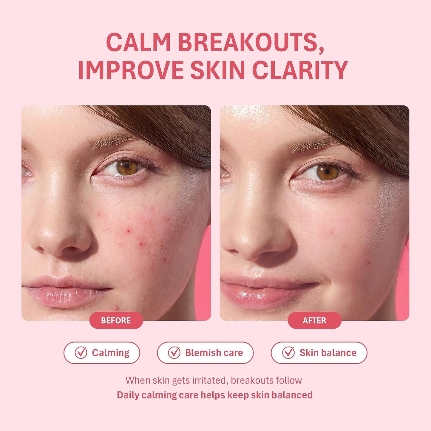 Salicylic Acid Acne Spot Treatment for Face, 0.67 Fl.Oz.